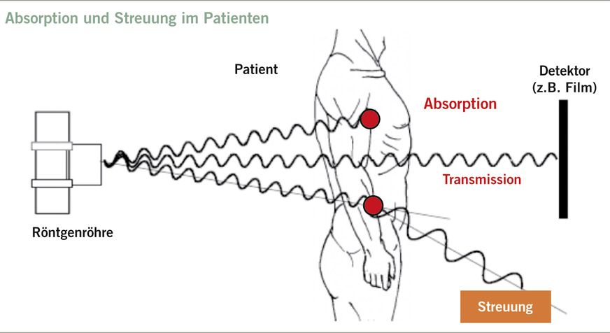 Abb. 2:  Strahlenbelastung bei Röntgenuntersuchungen. Aufteilung in Absorptionsstrahlung, ­Transmissionsstrahlung und Streustrahlung (Quelle: Marienhospital Herne, eigene Darstellung)