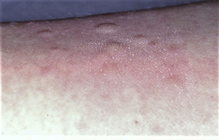 Abb. 3:  Reaktionen vom Soforttyp (Typ I) nach Tragen von Latexhandschuhen