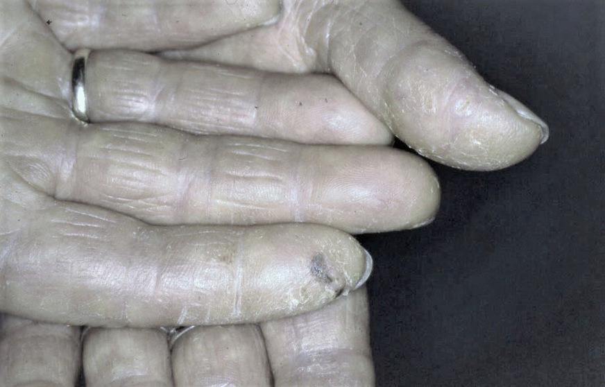 Abb. 5:  Auftreten bei Rhagaden im Bereich der Fingerkuppen
