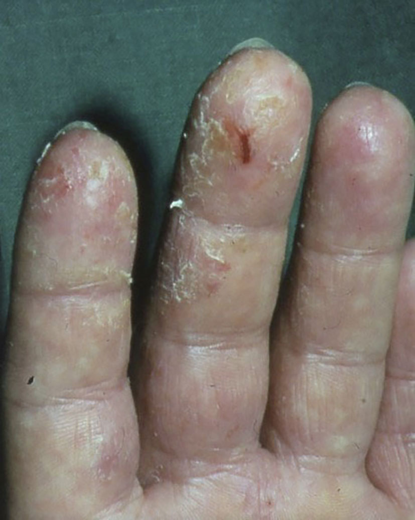 Abb. 6:  Allergisches Kontaktekzem: Fingerseitenkanten, -spitzen und Fingerzwischenräume zeigen Rötung, Schuppung und Rhagaden bei Kühlschmierstoffkontakt