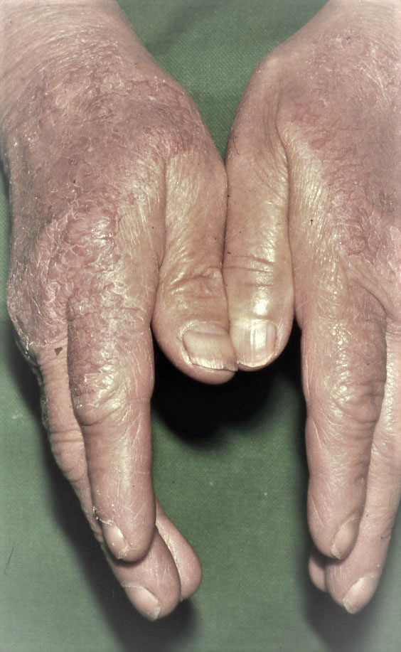 Abb. 2:  Bereits länger bestehendes chronisch-irritatives Kontaktekzem mit schwächerer Rötung, Schuppung und mit Fissuren im Bereich der Handrücken mit Übergang auf die Fingerstreckseiten