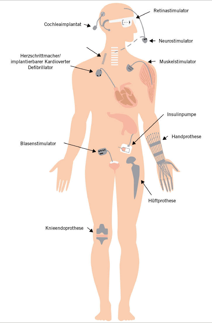 Abb. 3:  Überblick über aktive und passive Implantate (Quelle: BAuA)