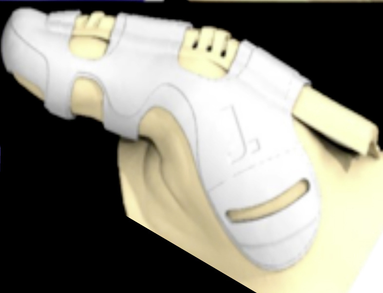 Abb. 5:  Ein Konzept mit dem Ziel einer Belastungsreduzierung am Daumen während der Clipsmontage (eigene Darstellung)