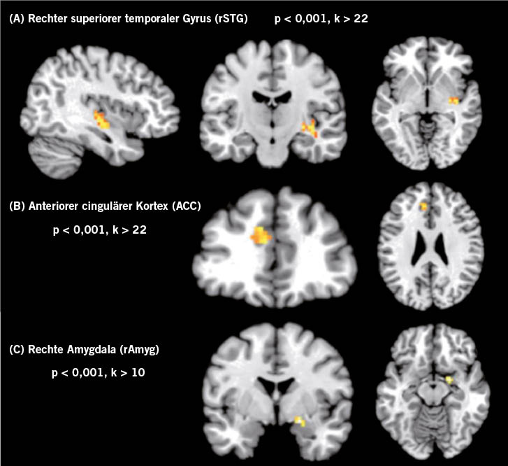 Abb. 3:  fMRI-Karten des Gehirns von Testpersonen mit Arealen erhöhter regionaler Homogenität (Konnektivität) während der Einwirkung von Infraschall unterhalb der Hörschwelle. Die virtuellen Schnittebenen liegen sagittal (links, nur bei A) frontal (Mitte) und transversal (rechts). Regionen mit Unterschieden zur Kontrollgruppe (ohne Schalleinwirkung) sind farbig markiert. 14 Versuchspersonen wurden im Ruhezustand für 200 s mit Infraschall von 12 Hz Sinus behandelt. Die Intensität wurde 2 dB unterhalb der (vorher ermittelten) individuellen Hörschwelle eingestellt. Während dieser Zeit wurden fMRI-Messungen durchgeführt und anschließend mittels der regionalen Homogenitätsanalyse (s.o.) auf Bereiche höherer neuronaler Aktivität untersucht, im Vergleich zu fehlender Beschallung. Die dabei gefundenen Regionen sind farbig markiert. Die markierten Veränderungen traten nicht auf, wenn die Schalleinwirkung bei gleicher Frequenz, jedoch mit einer für die Testperson hörbaren Intensität, erfolgte. Diese Intensität wurde nicht als schmerzhaft empfunden (individuell ermittelt in einem Vorversuch). Quelle: Weichenberger et al. 2017Fig.&nbsp;3: fMRI maps of the brain of test subjects with areas of higher regional homogeneity (connectivity) during exposure to infrasound below the hearing threshold level. The virtual planes are sagittal (left, A only), frontal (centre) and transverse (right). Regions with differences to the control group (without sound exposure) are marked in colour. 14 test subjects were treated in a state of rest with 12 Hz infrasonic waves for 200 s. The intensity was set 2 dB below their individual hearing threshold (as determined previously). fMRI measurements were taken during this time and the regional homogeneity analysis (see above) was then used to examine them for areas of higher neuronal activity in comparison with the absence of exposure to sound. The regions found during this process are marked in colour. The marked changes did not occur during exposure to sound at the same frequency but at an intensity that was audible to the test subject. This intensity was not perceived as painful (individually ascertained in a preliminary trial). Source: Weichenberger et al. 2017