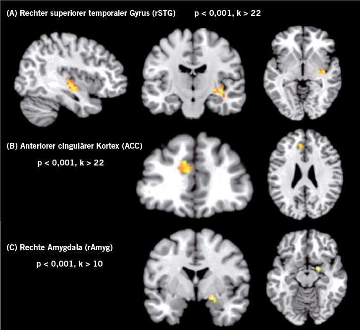 Abb. 3:  fMRI-Karten des Gehirns von Testpersonen mit Arealen erhöhter regionaler Homogenität (Konnektivität) während der Einwirkung von Infraschall unterhalb der Hörschwelle. Die virtuellen Schnittebenen liegen sagittal (links, nur bei A) frontal (Mitte) und transversal (rechts). Regionen mit Unterschieden zur Kontrollgruppe (ohne Schalleinwirkung) sind farbig markiert. 14 Versuchspersonen wurden im Ruhezustand für 200 s mit Infraschall von 12 Hz Sinus behandelt. Die Intensität wurde 2 dB unterhalb der (vorher ermittelten) individuellen Hörschwelle eingestellt. Während dieser Zeit wurden fMRI-Messungen durchgeführt und anschließend mittels der regionalen Homogenitätsanalyse (s.o.) auf Bereiche höherer neuronaler Aktivität untersucht, im Vergleich zu fehlender Beschallung. Die dabei gefundenen Regionen sind farbig markiert. Die markierten Veränderungen traten nicht auf, wenn die Schalleinwirkung bei gleicher Frequenz, jedoch mit einer für die Testperson hörbaren Intensität, erfolgte. Diese Intensität wurde nicht als schmerzhaft empfunden (individuell ermittelt in einem Vorversuch). Quelle: Weichenberger et al. 2017Fig. 3: fMRI maps of the brain of test subjects with areas of higher regional homogeneity (connectivity) during exposure to infrasound below the hearing threshold level. The virtual planes are sagittal (left, A only), frontal (centre) and transverse (right). Regions with differences to the control group (without sound exposure) are marked in colour. 14 test subjects were treated in a state of rest with 12 Hz infrasonic waves for 200 s. The intensity was set 2 dB below their individual hearing threshold (as determined previously). fMRI measurements were taken during this time and the regional homogeneity analysis (see above) was then used to examine them for areas of higher neuronal activity in comparison with the absence of exposure to sound. The regions found during this process are marked in colour. The marked changes did not occur during exposure to sound at the same frequency but at an intensity that was audible to the test subject. This intensity was not perceived as painful (individually ascertained in a preliminary trial). Source: Weichenberger et al. 2017