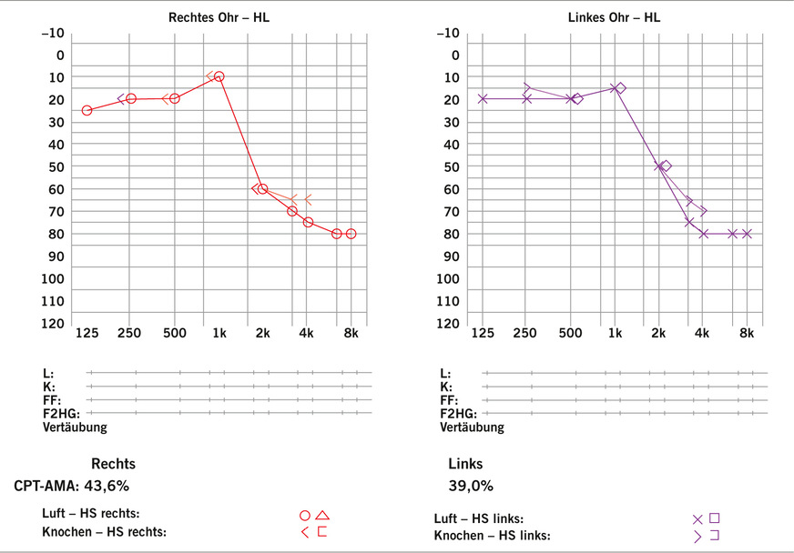 Abb. 7:  Tonaudiogramm mit Hochtonsteilabfall beidseits bei Anerkennung als Berufskrankheit (Quelle: Arbeitsmedizinische Gehörschadenprävention der Suva)