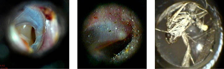 Abb. 2:  Links: Trommelfelldefekt, Mitte: Sandstrahlerbefund, rechts: Insekt im Gehörgang