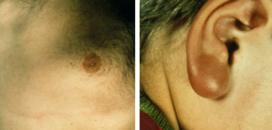 Abb. 6: Borreliosesymptome. Links: Ausbleichen des Erythems; rechts: Rosacea-migrans-Schwellung