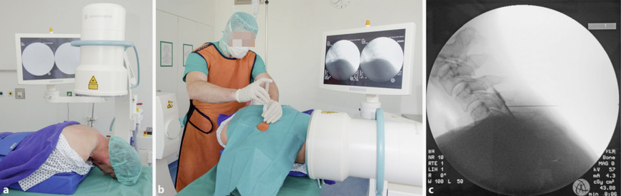 Abb. 1: Zervikal-epidurale Injektion. a Lagerung des Patienten, b Injektion mit Loss-of-Resistance-Phänomen, c Darstellung des Epiduralkanals mit Kontrastmittel