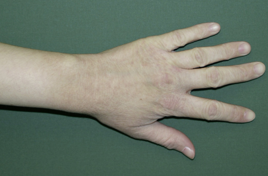 Abb. 2:  Ekzem im Bereich des Handrückens, Unterarm und der Fingerstreckseiten bei Waschzwang (gleiche Patientin wie Abb. 1)