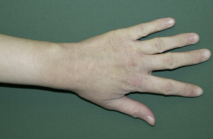 Abb. 2: Ekzem im Bereich des Handrückens, Unterarm und der Fingerstreckseiten bei Waschzwang (gleiche Patientin wie Abb. 1)