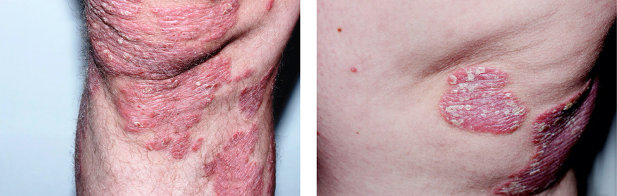 Abb. 3:  Erythematosquamöse Hautläsionen (Schuppenherde auf scharf begrenzten roten Plaques, typisch für Psoriasis vulgaris)