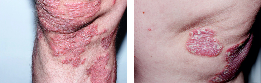 Abb. 3: Erythematosquamöse Hautläsionen (Schuppenherde auf scharf begrenzten roten Plaques, typisch für Psoriasis vulgaris)
