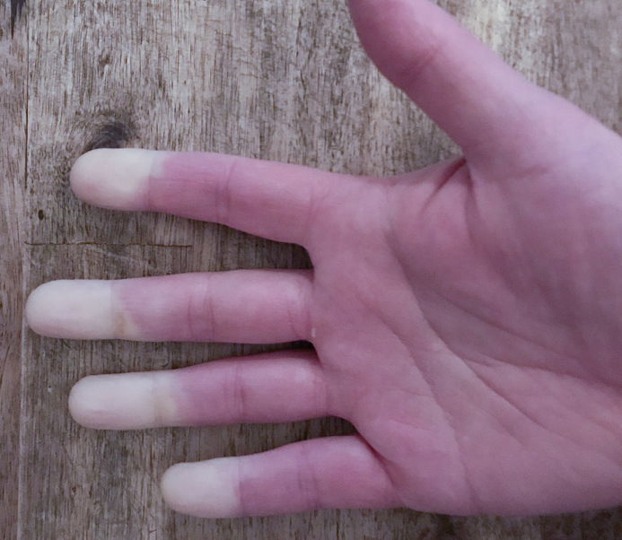 Abb.&nbsp;6:  Weißfinger