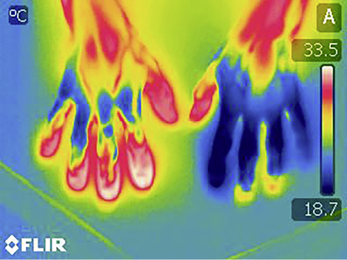 Abb. 7:  Wärmebild nach Kälteprovokationstest (ICE) bei Patient mit VVS