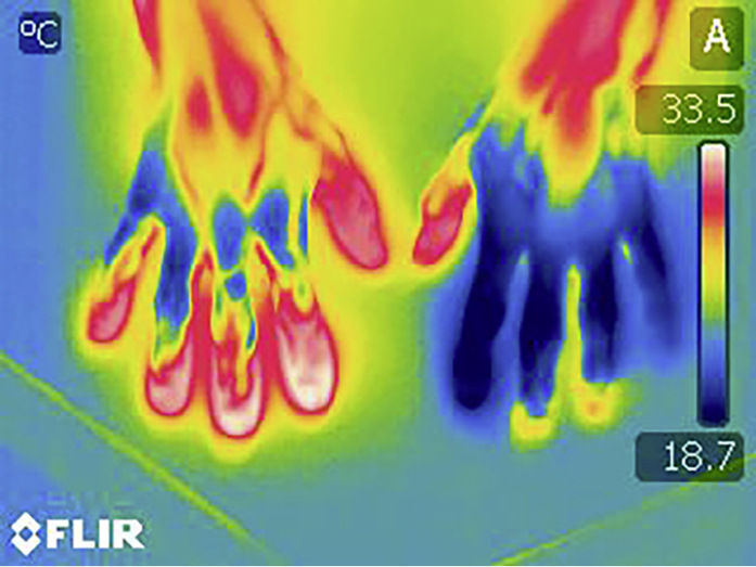 Abb.&nbsp;7:  Wärmebild nach Kälteprovokationstest (ICE) bei Patient mit VVS