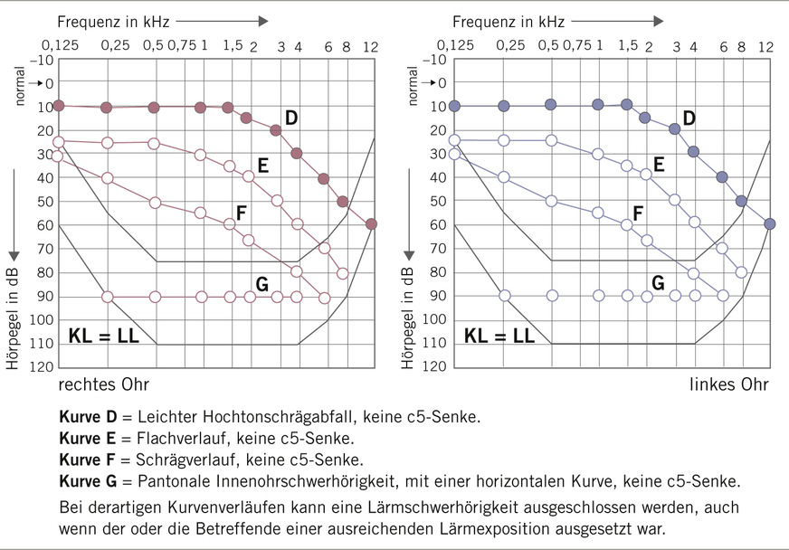 Abb. 2: Tonaudiometrische Kurvenverläufe, die mit dem Vorliegen einer Lärmschwerhörigkeit nicht vereinbar sind (Brusis 2021, 2022)
