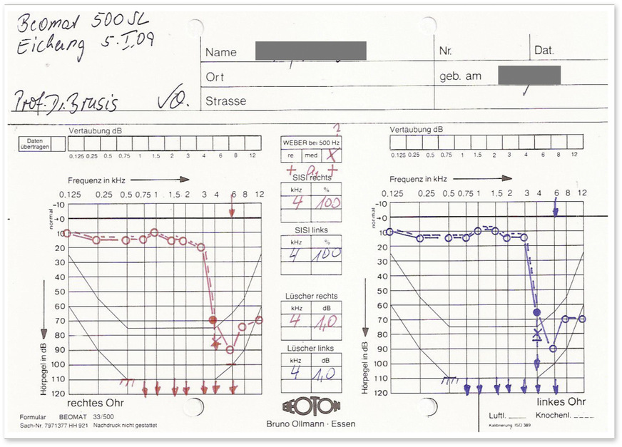 Abb.&nbsp;2:  Typischer tonaudiometrischer Befund nach einem oder mehreren Knalltraumen bei einem Stahlbauschlosser in der Bundeswehrzeit als Ladeschütze bei einer Panzereinheit. Typisch ist im Gegensatz zur c5-Senke bei einer Lärmschwerhörigkeit der Steilabfall im Hochtonbereich bei Knalltrauma. Daher liegt keine BK 2301 vor, sondern eine WDB (Wehrdienstbeschädigung). Der Tinnitus bei 6000 Hz ist als Begleittinnitus des Knalltraumas einzustufen