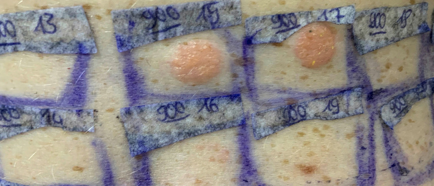 Abb. 2: Positive Testreaktionen auf das mitgebrachte Kühlschmiermittel bei einem 20-jährigen Metallfacharbeiter (Foto: Prof. E. Weisshaar, Sektion Berufsdermatologie, Universitätsklinikum Heidelberg)