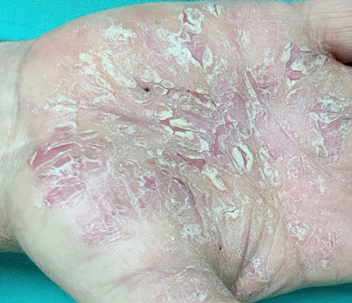 Abb. 3: Psoriasis palmaris bei einem 58-jährigen Hausmeister. Es bestanden auch psoriatische Effloreszenzen an der Körperhaut, z. B. Ellenbogen, Knie, Capillitium (Foto: Prof. E. Weisshaar, Sektion Berufsdermatologie, Universitätsklinikum Heidelberg)