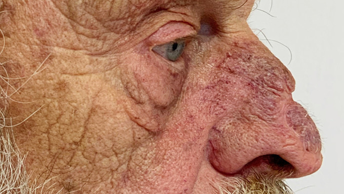 Abb. 4: Beruflich bedingter Hautkrebs mit Plattenepithelkarzinom (Apex nasi). Zustand nach operativer Therapie mit Melolabiallappen und kosmetisch entstellendem und funktionell beeinträchtigendem Defektsyndrom der Oberlippenmuskulatur und -sensibilität links, konsekutiv objektivierbaren motorischen und sensorischen Ausfällen sowie resultierenden Funktionsstörungen (Essen, Trinken) (Foto: Prof. E. Weisshaar, Sektion Berufsdermatologie, Universitätsklinikum Heidelberg)