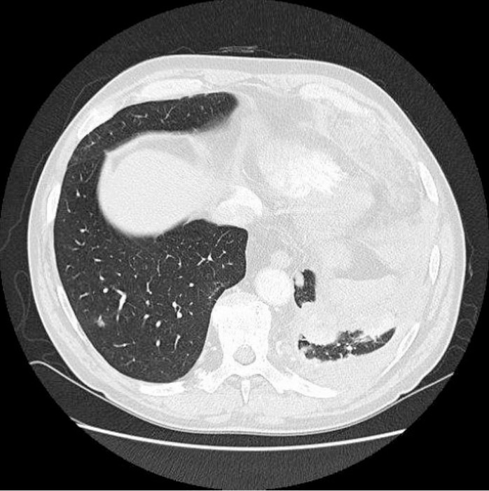 Abb. 2:  CT-Thorax 2015