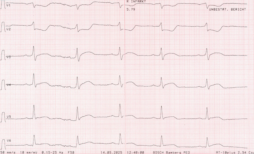 Abb. 2:  Brustwand-EKG-Ableitungen
