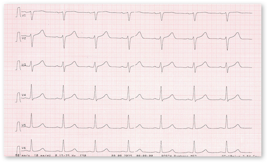 Abb. 2:  Brustwand-EKG-Ableitungen