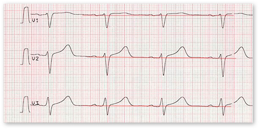 Abb. 3:  Brustwand-EKG-Ableitungen V1–V3 vergrößert