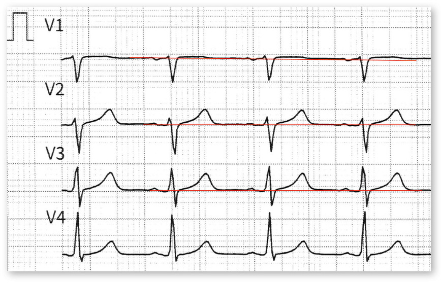 Abb. 4:  EKG im Verlauf nach Gabe von Heparin und Aspirin