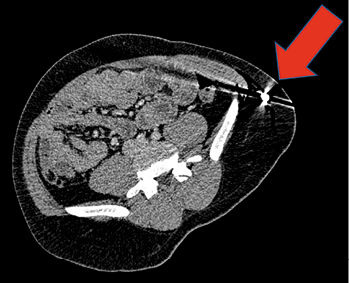 
 Abb. 2: 
 CT-Abdomen: Die hier getroffene Schicht zeigt deutlich, dass das Moniereisen zwar eingedrungen ist, den Peritonealraum aber weder eröffnet noch lebenswichtige Organe getroffen hat
