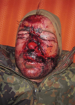 
 Abb. 2: 
 Gesichtsverletzungen des Absturzopfers (Foto: M. Tannheimer)
