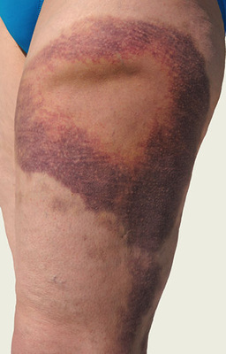 
 Abb. 4: 
 Bluterguss nach Bagatelltrauma und ASS-Einnahme (Foto: P. Jansing)
