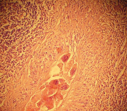 <p>
<span class="GVSpitzmarke"> Abb. 2: </span>
 Eigranulom der Art Schistosoma haematobium in der Blasenwand (Foto: Rieke)
</p>