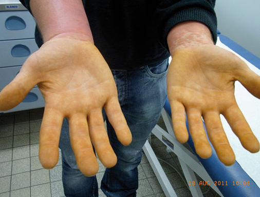 
 Abb. 2: 
 Verfärbungen der Hohlhände bei initaler ärztlicher Vorstellung



