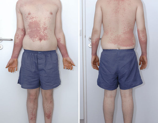 
 Abb. 3: 
 Generalisiertes Ekzem neun Tage nach Kontakt mit TMH



