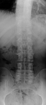 
 Abb. 1: 
 LWS p.a. nativ (R.W.). Geringe Skoliose der Wirbelsäule im thorakolumbalen Übergang ohne Verdrehung. Verstrichenen Ileosakralgelenksfuge links. Keine lumbale Übergangsstörung



