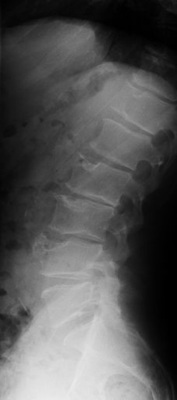 <p>
 Abb. 2: 
 LWS seitlich nativ (R.W.). Schwer-gradige Endplatteneinbrüche mit Schmorl´-schen Knötchen in allen Segmenten bis auf LWK 1. Im Segment LWK 4 ausgeprägter flächenhafter Einbruch, der ursprünglich als Tumor gedeutet wurde. Endplattennahe Verdichtungen der Knochenstruktur als Hinweis auf die gestörte Diffusion, allgemeine Bandscheibenhöhenminderung.
</p>

<p class="GVBildunterschriftEnglisch">
</p>