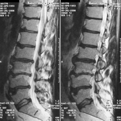 <p>
 Abb. 3: 
 MRT seitlich LWS (R.H.). Schwer-gradige degenerative Veränderungen der Segmente L2 bis L5 mit Erweichungen der Bandscheiben und Protrusionen in alle Richtungen. Die Endplattenveränderungen sind überwiegend an den Wachstums-fugen gelegen, bei L5 mit flächenhaftem Einbruch der Deckplatte. Hochgradiges Knochenmarksödem bei L3/4 als Merkmal des Zusammenbruchs der Diffusion im Knochen. Schwergradige Verfettung der Rückenmuskulatur in den degenerativ veränderten Segmenten. Auch die Kreuzbeinbasis ist betroffen mit Einbrüchen der Knorpelschicht
</p>

<p class="GVBildunterschriftEnglisch">
</p>