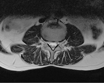 <p>
 Abb. 6: 
 MRT- LWS von 28. 11. 2013 im Segment LWK 4, axialer Schnitt (R.W.). Flächenhafte Infrak-tion der Deckplatte und Abscherung des ventra-len Anteils der Wachstumsfuge. Von den Wirbelbögen ausgehende Verfettung der Rückenmuskulatur mit Betonung der Faszienbündel
</p>

<p class="GVBildunterschriftEnglisch">
</p>