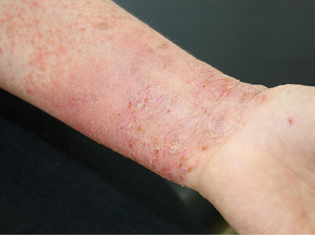 
 Abb. 1: 
 Ekzem = chronische Dermatitis (Polymorphie)
