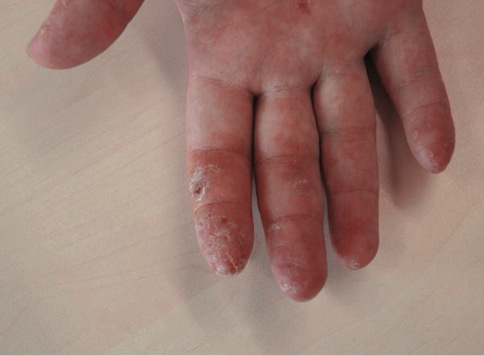 
Allergisches Fingerkuppen-ekzem bei einem Zahn-techniker mit Typ-IV-Sensibilisierungen gegen-über (Meth-)Acrylaten
