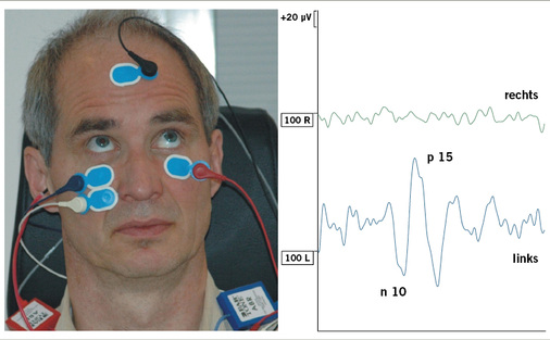 
 Abb. 3: 
 Links: Elektrodenanordnung und akustische Stimulation (rechts) für okulär abgeleitete vestibulär evozierte Potentiale (o-VEMP) nach kontralateraler Stimulation zur seitengetrennten Überprüfung der Utrikulus-Funktion (Burstreizung bei 100 dB nHL (500 Hz). Rechts: Biphasisches Muskelpotenzial nach ca. 10 und 15 ms für die linke Ableitung, rechts keine Ableitung möglich
