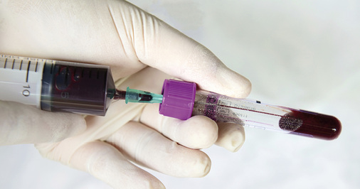 



Für analytische Untersuchungen sind Proben von venösem Blut mit Zusatz von Antikoagulans erforderlich
