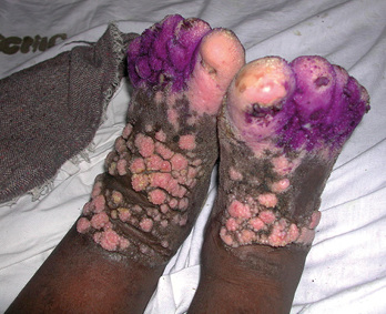 



 Abb. 2: 
 Mossy Foot mit Hyperkeratose im KCMC in Tansania
