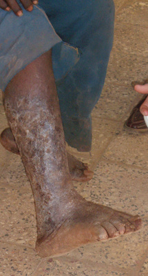 



 Abb. 3: 
 Podokoniose mit beginnender Elephantia-sis im Sodo Christian General Hospital
