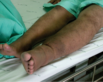 



 Abb. 4: 
 Lymphatische Filariose in der Mahidol Universität, Thailand
