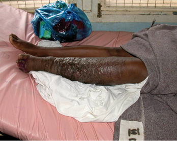 



 Abb. 5: 
 Epidemisches Kaposi-Sarkom mit Elephan-tiasis im KCMC in Moshi, Tansania
