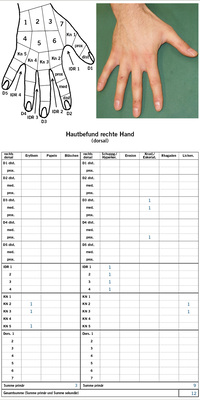 
 Abb. 2: 
 HEROS – Beispiel des Befundbogens für den rechten Handrücken
