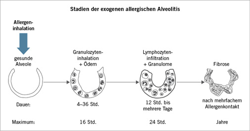 <p>
<span class="GVSpitzmarke"> Abb. 2: </span>
 Stadien der exogenen allergischen Alveolitis
</p>

<p class="GVBildunterschriftEnglisch">
</p>